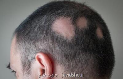 یافتن یک گونه قارچی جدید ایجادکننده کچلی در ایران