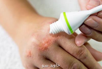 تاثیر پمادی حاوی عصاره های گیاهی در کاستن علائم اگزما